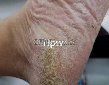 Τριπλη θεραπεία keratolytic για καθαρές φτερνες - 3