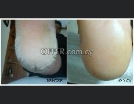 Τριπλη θεραπεία keratolytic για καθαρές φτερνες - 5